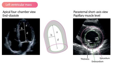 Left ventricular mass and volume (size) – Cardiovascular Education